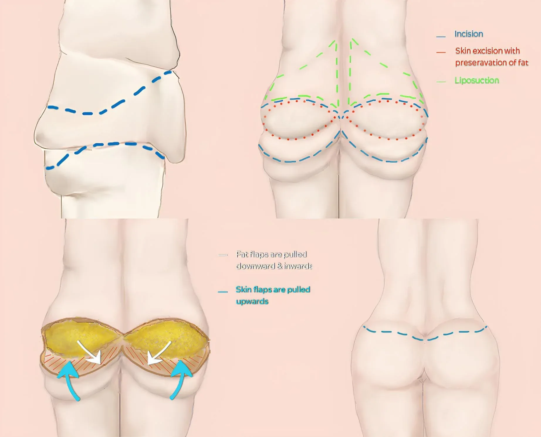 360 body lift abdominoplasty technique illustration