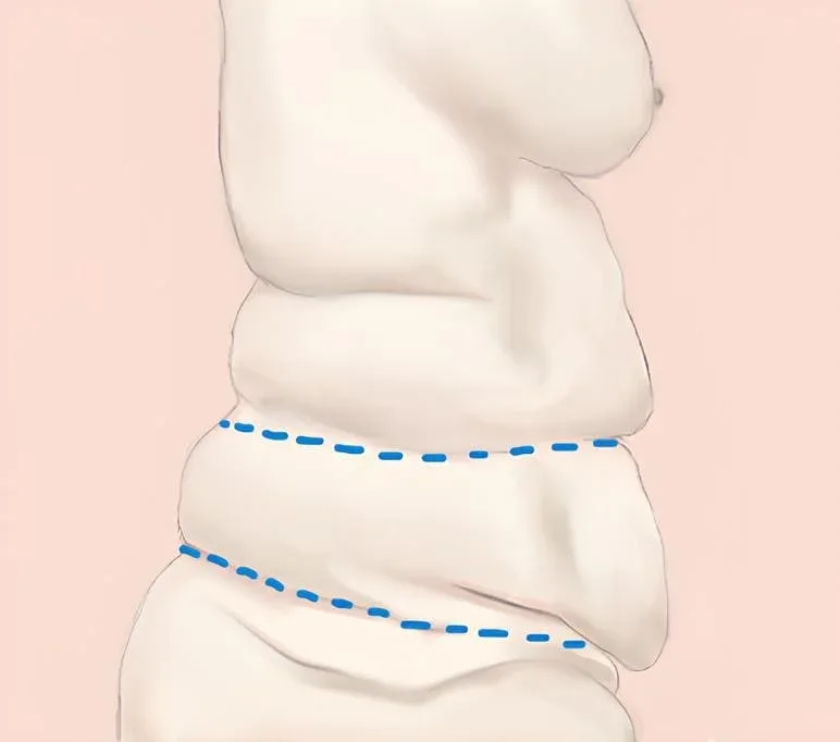 Belt lipectomy technique illustration