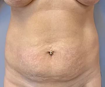 Abdomen after laser liposuction, showing residual skin redundancy