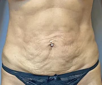 Abdomen before laser liposuction