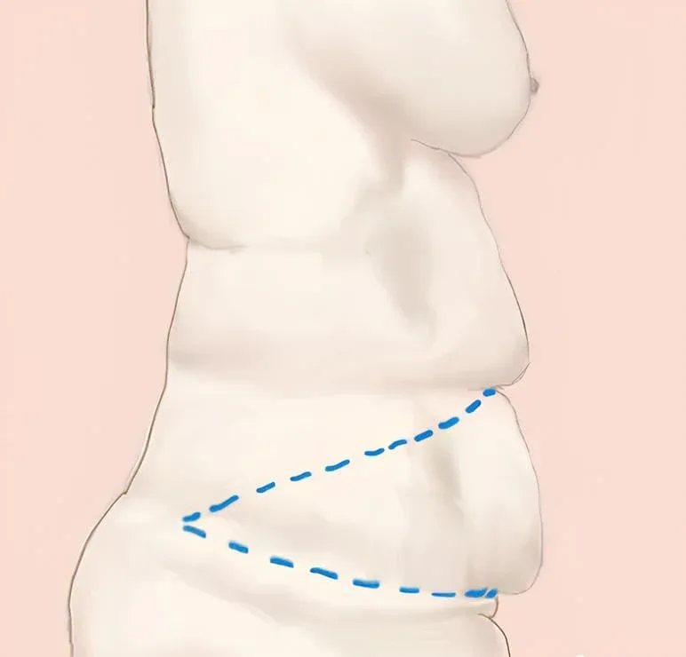Extended abdominoplasty technique illustration