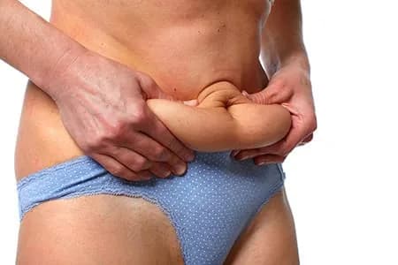 Grabbing the lower abdominal skin to test for tummy-tuck candidacy
