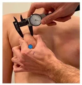 Messung der Hautdicke mit einem Pinchmeter