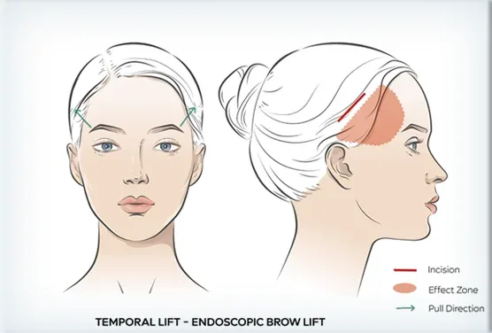 Temporal lift and endoscopic brow lift technique illustration