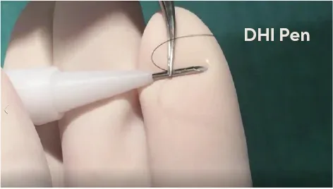 Choi implanter pen used in DHI hair transplantation
