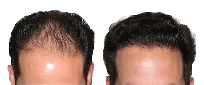 Hair transplantation result - a denser frontal hairline