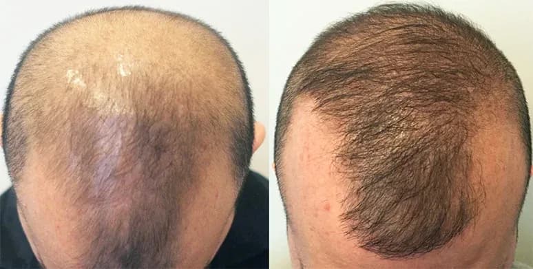 Advanced hair loss over a wide area of the scalp