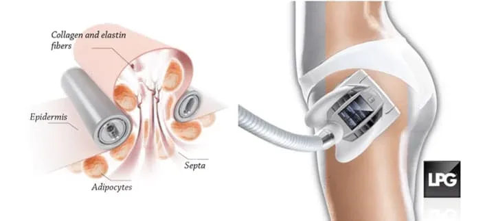LPG Lipomassage device used after liposuction