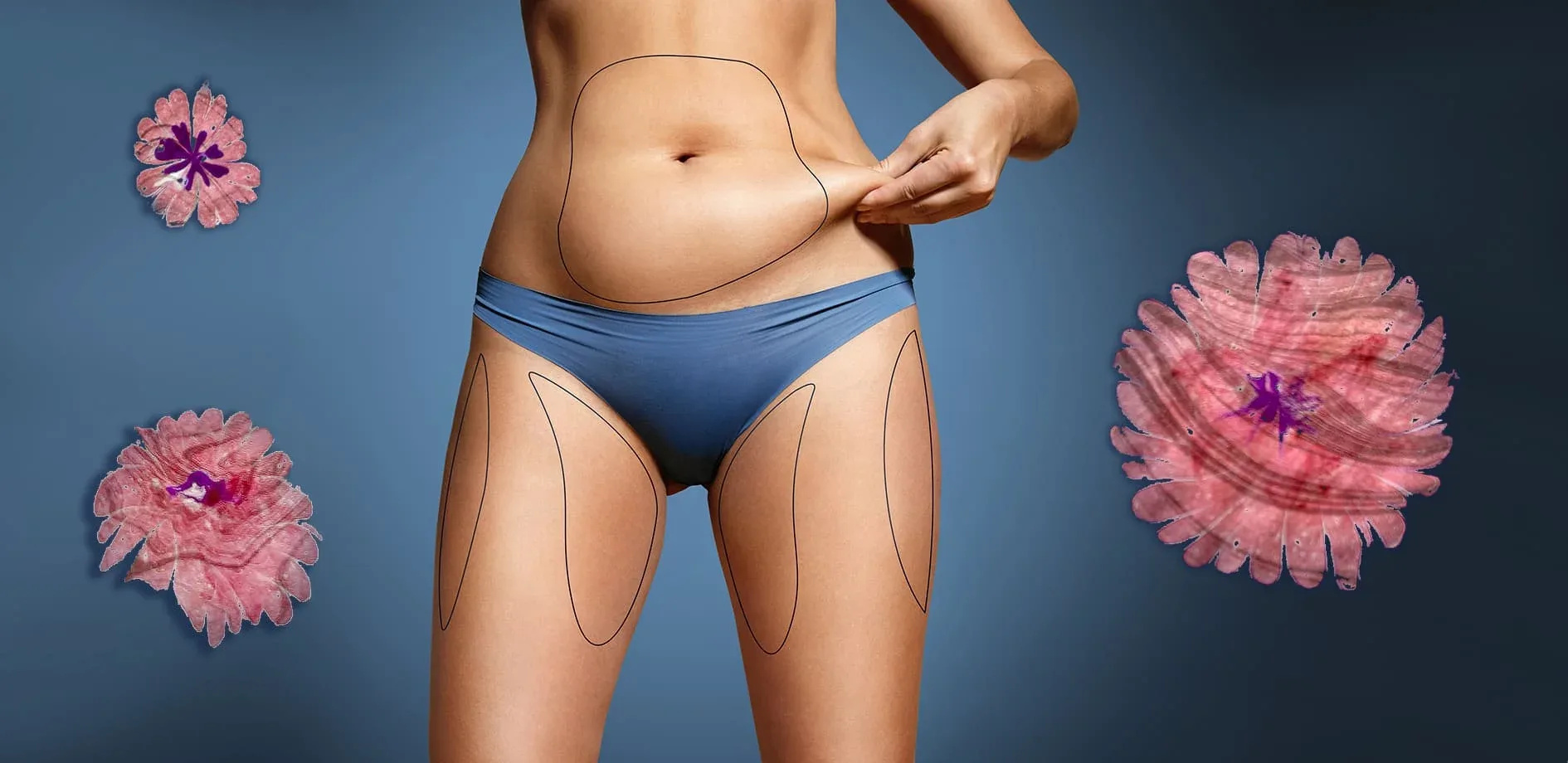 Preparation for Abdominoplasty