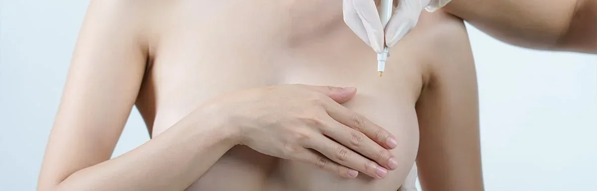 Marking the inframammary incision