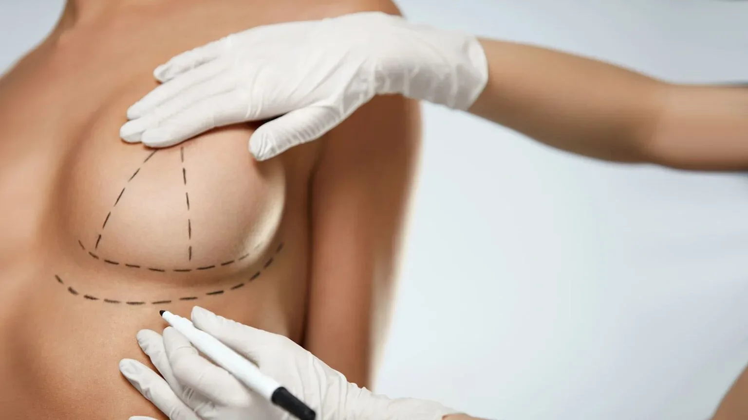 Assessing the need for a breast lift