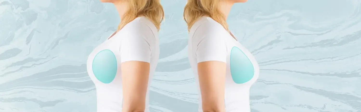 Breast augmentation result example