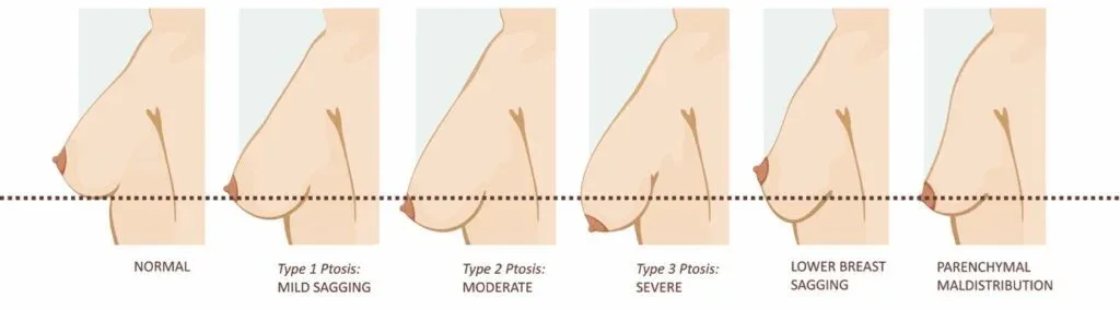 Degrees of breast ptosis (sagging)