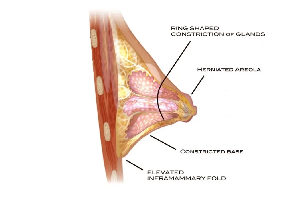 Anatomy of a tubular (constricted) breast