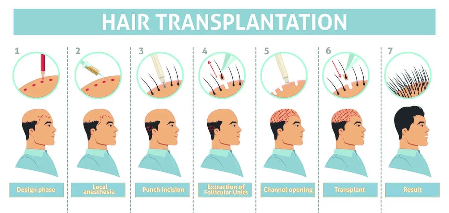 Transplantation Procedure