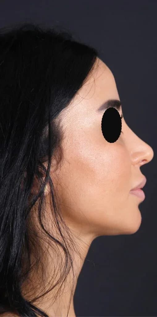 Rhinoplasty simulation — projected after view