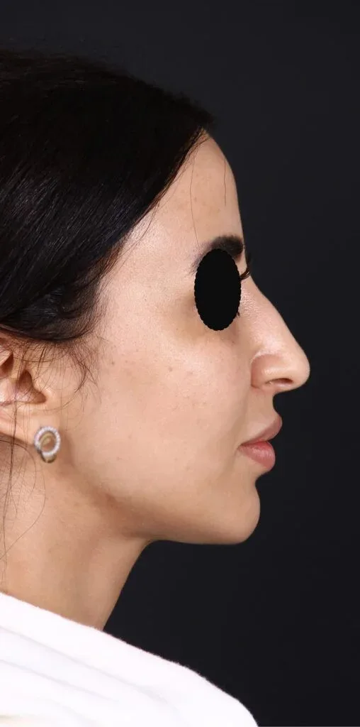 Rhinoplasty simulation — before view