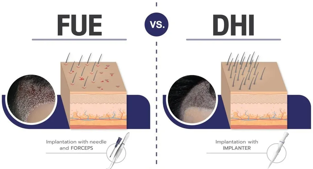 Side-by-side comparison of DHI and FUE hair transplant techniques