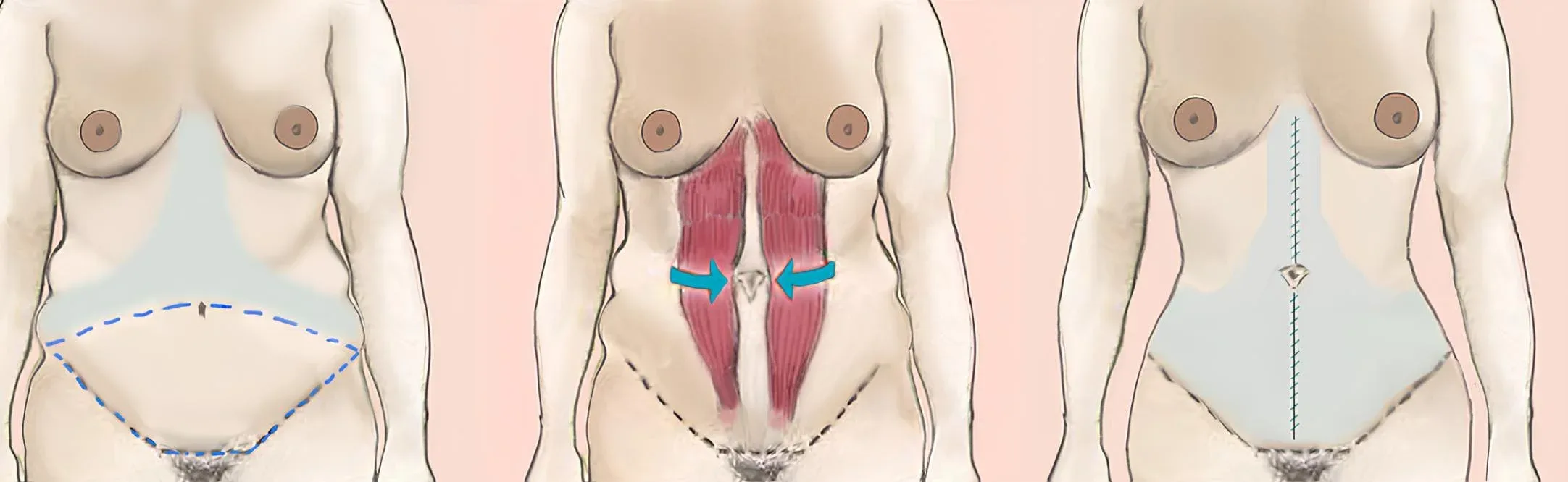 Klasik abdominoplasti: kesi planlaması, ayrılmış kasların orta hatta birleştirilmesi (plikasyon) ve kapama