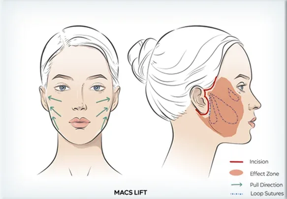 MACS lift çizimi: minimal kesi ve asıcı dikişlerle germe