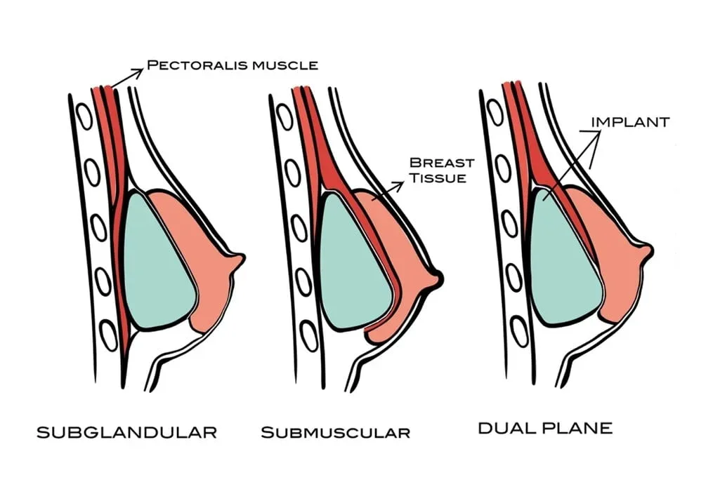 Protez yerleşim düzlemleri: doku altı (subglandular), kas altı (submüsküler) ve dual plan